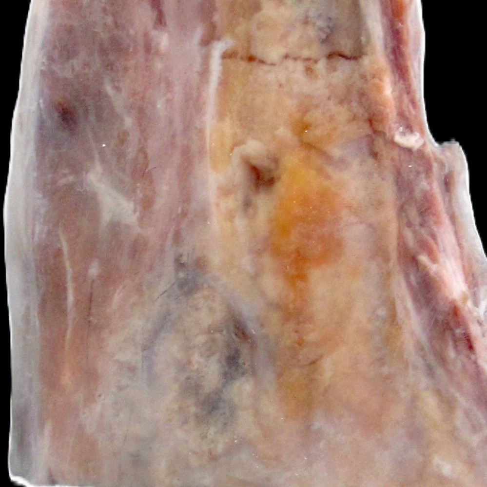 Osteosarkom
Femur mit einem Osteosarkom. 